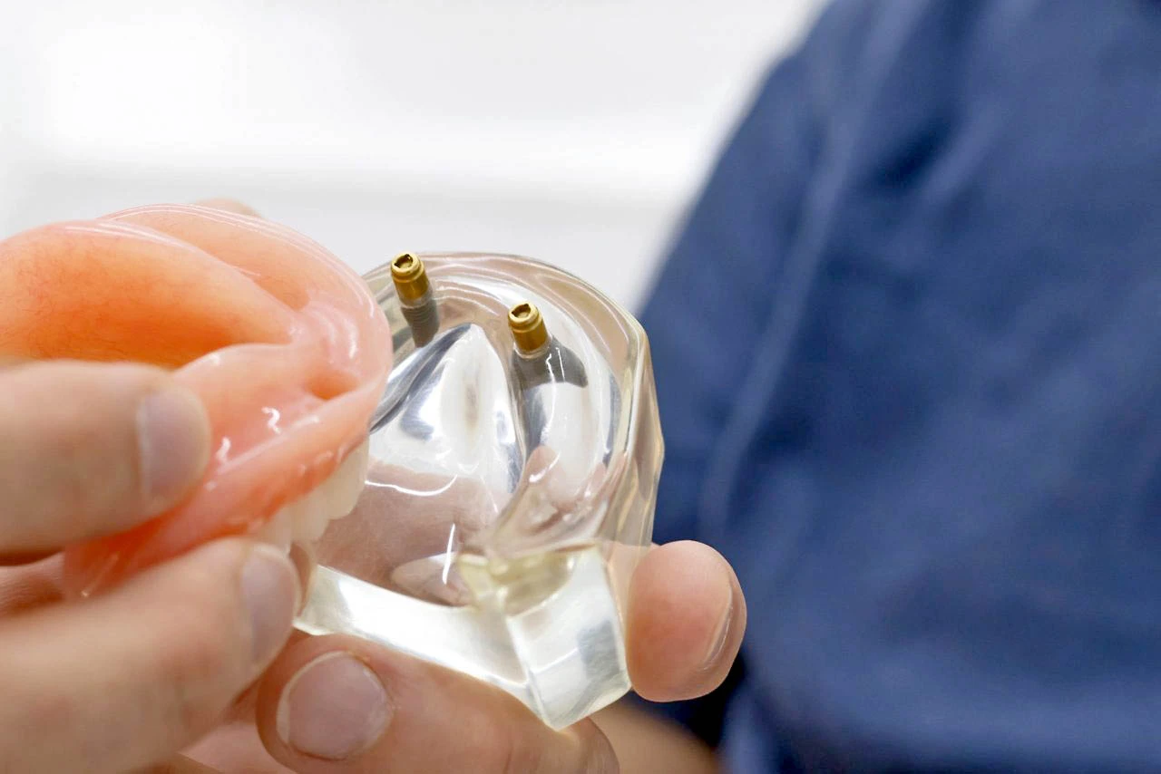 Implantes dentales en Logroño Sur - Colocación de corona sobre implante
