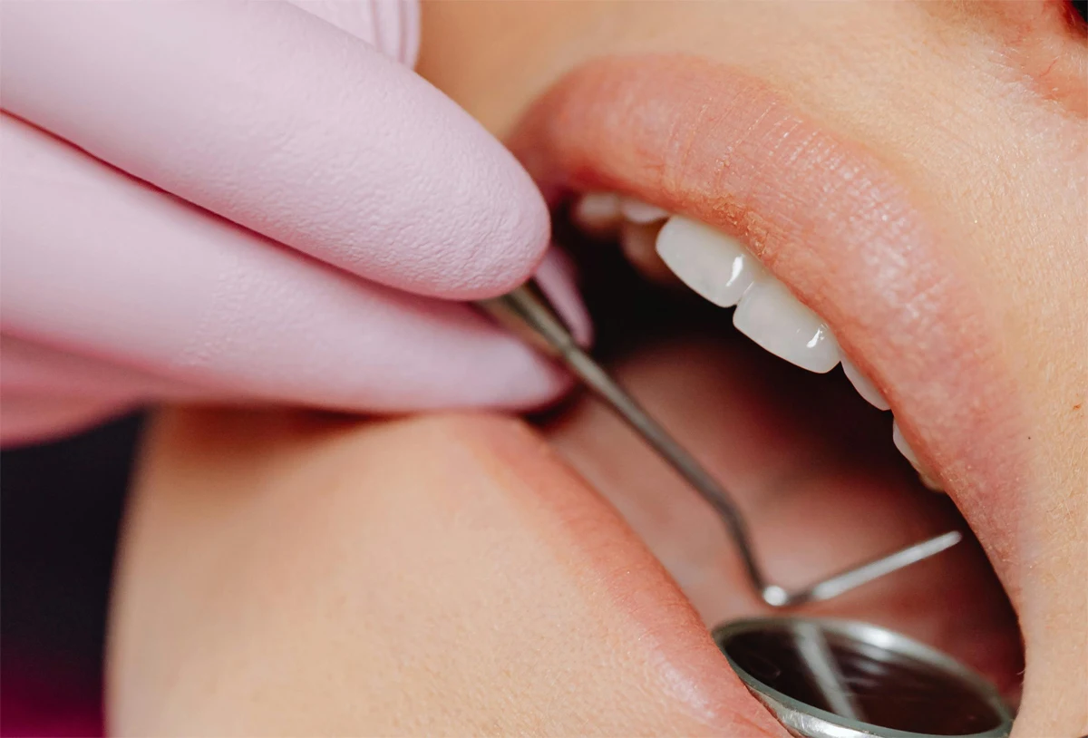 Endodoncia en Logroño Sur - Tratamiento del nervio dental