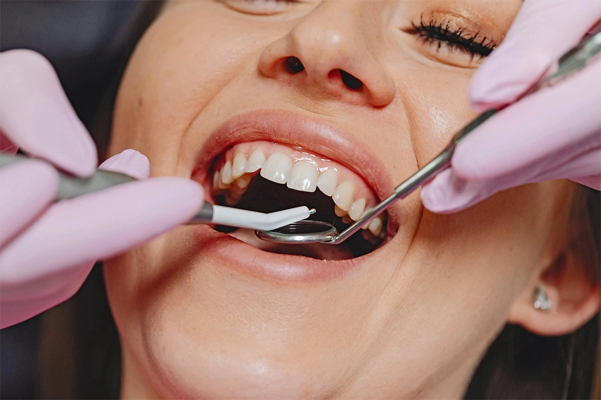 Limpieza dental profesional en Logroño Sur - Eliminación de sarro y placa